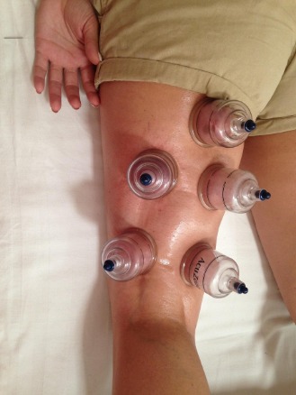 Cupping therapy